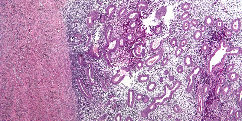 Micrographie de l'endométriose de l'ovaire - 