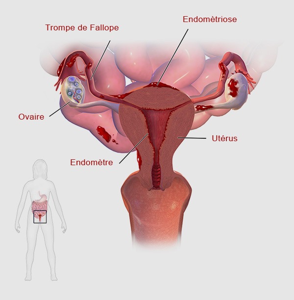 schema.endometriose